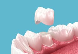 Dental crowns