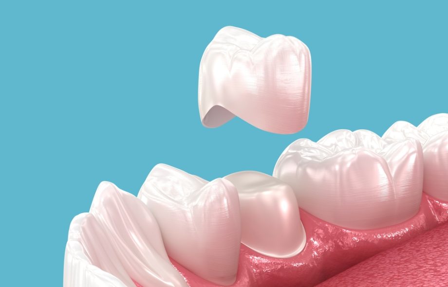 Dental crowns