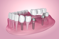 Dental Bridges