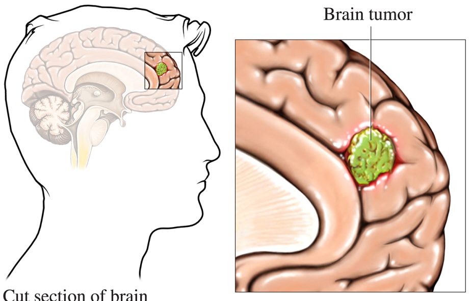 brain tumor