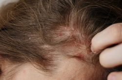 eczema and hair thinning