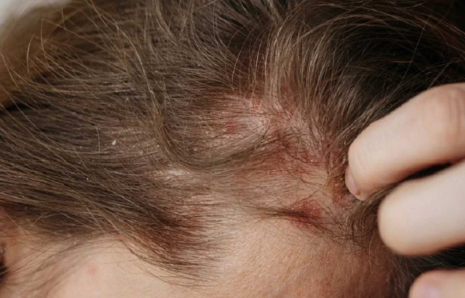 eczema and hair thinning