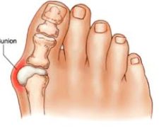 Bunion Surgery in perth