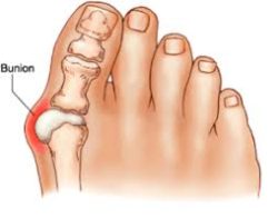 Bunion Surgery in perth