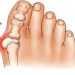 Bunion Surgery in perth