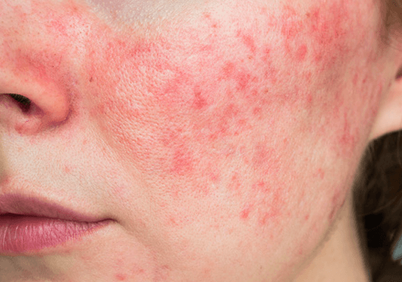 skin infection treatment near me