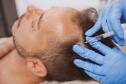 A hair transplant specialist doing prp hair treatment