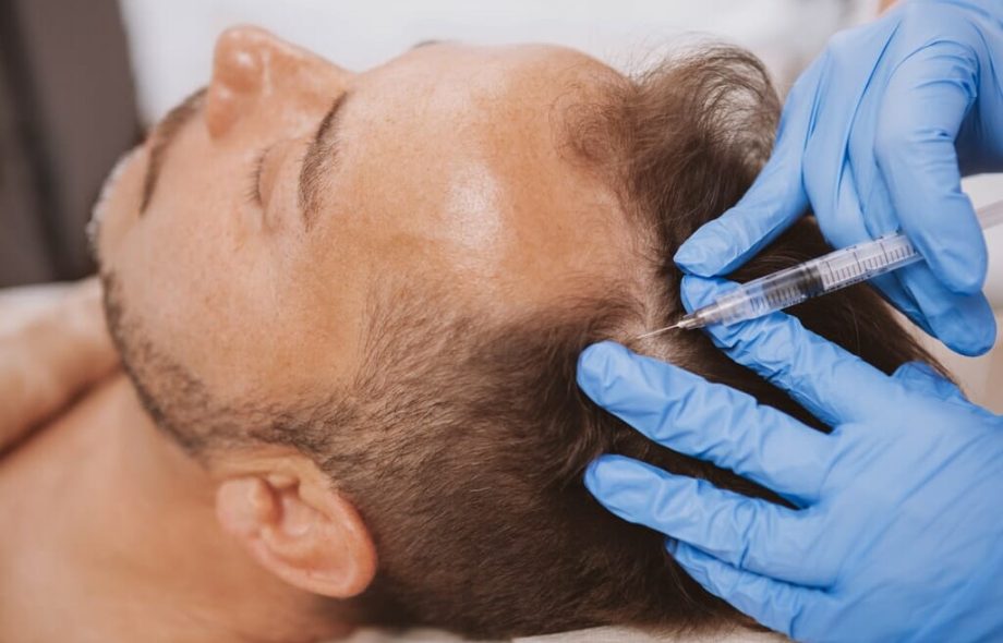 A hair transplant specialist doing prp hair treatment