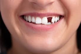 Replacing missing teeth is not just about aesthetics; it significantly impacts your self-confidence and overall well-being. When you restore your smile, you’ll find yourself smiling more freely, speaking more clearly, and eating comfortably. With modern dental advancements, there are effective solutions for everyone, regardless of age or budget.