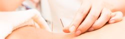 fertility acupuncture Melbourne