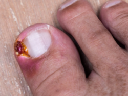 ingrown toenail