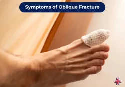 oblique fracture