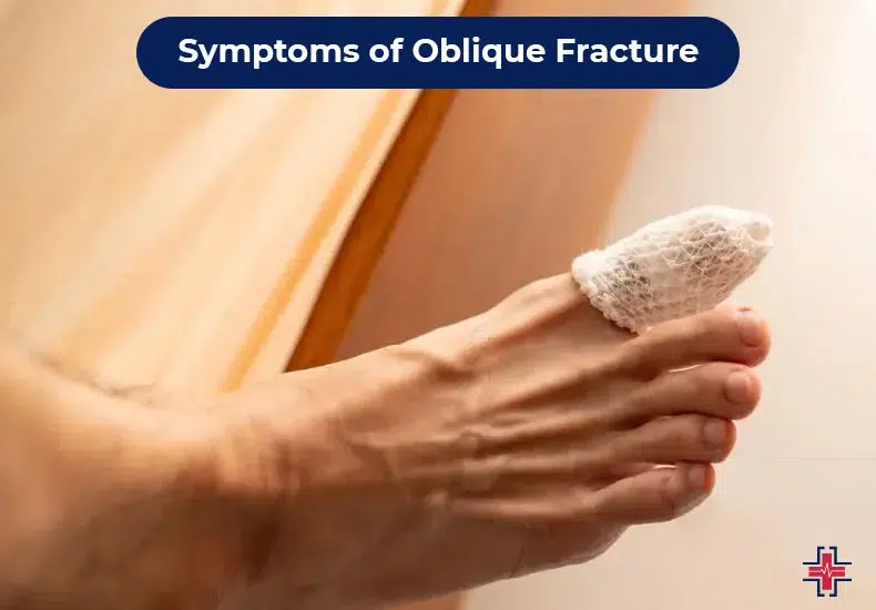 oblique fracture