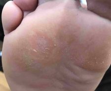 Plantar Warts Treatment