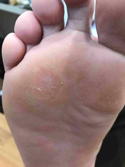 Plantar Warts Treatment