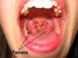 Tonsillitis