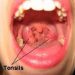 Tonsillitis