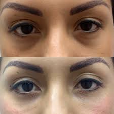 A close-up of a woman’s eyes before and after under-eye filler treatment, showing a smoother, more refreshed appearance.