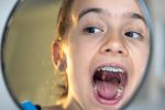 What to Expect When Your Child Needs a Palate Expander