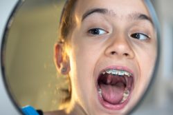 What to Expect When Your Child Needs a Palate Expander