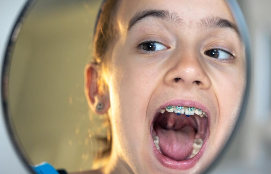 What to Expect When Your Child Needs a Palate Expander