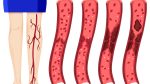 dvt symptoms
