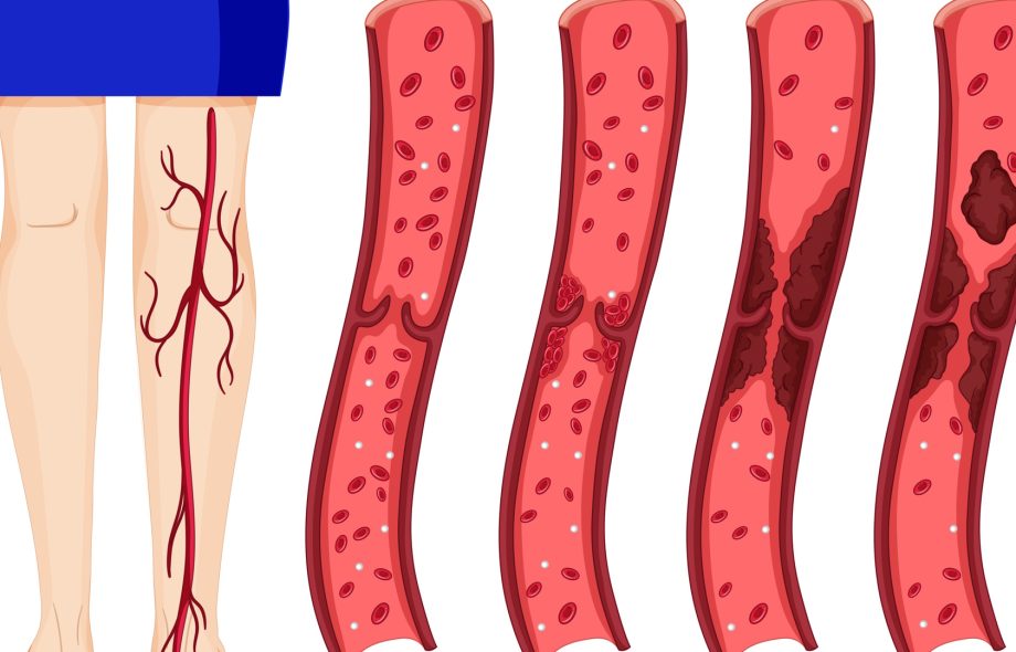 dvt symptoms
