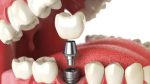 Best Dentist Cost in ahmedabad