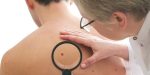 squamous cell carcinoma treatment Irvine CA