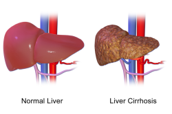 Critical Early Signs of Liver Cirrhosis You Should Not Overlook