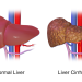 Critical Early Signs of Liver Cirrhosis You Should Not Overlook