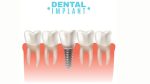 Dental Implants Cost in ahmedabad