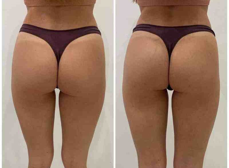 Non-invasive butt lift