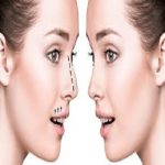Rhinoplasty