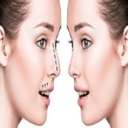 Rhinoplasty