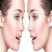 Rhinoplasty