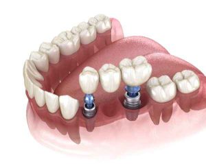 Dental-Implant