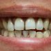 Remove Stains from Teeth