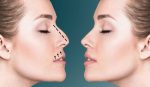 RHINOPLASTY SURGERY Dubai