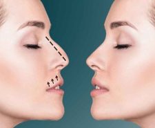 RHINOPLASTY SURGERY Dubai