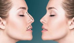 RHINOPLASTY SURGERY Dubai