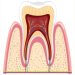 Root Canal Treatment in Ahmedabad