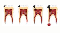 Root Canal Treatment in Ahmedabad