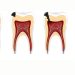 Root Canal Treatment in Ahmedabad