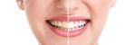 teeth whitening chippewa falls
