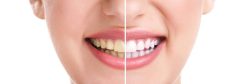 teeth whitening chippewa falls