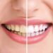 teeth whitening chippewa falls