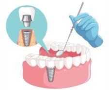 Dental Implants Cost Ahmedabad