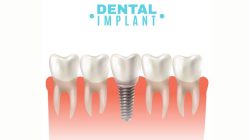 Dental Implants in Ahmedabad