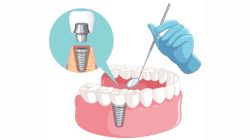 Dental Implants in Ahmedabad